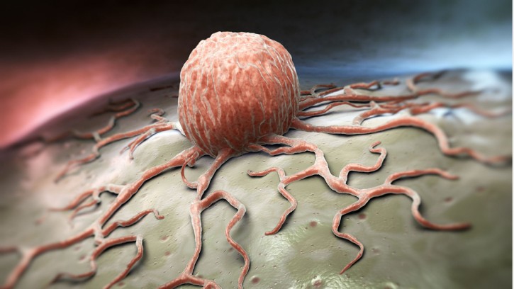 ক্যান্সার হওয়ার ১ বছর আগে যেসব পূর্ব লক্ষণ দেখা দেয়